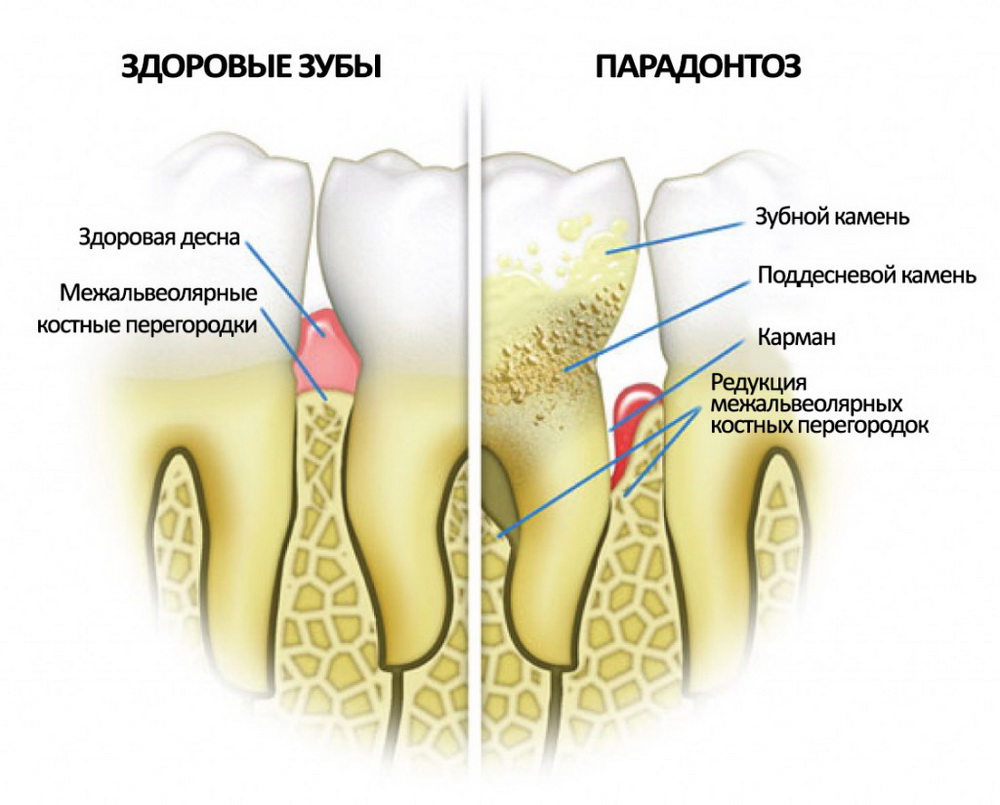parodontit